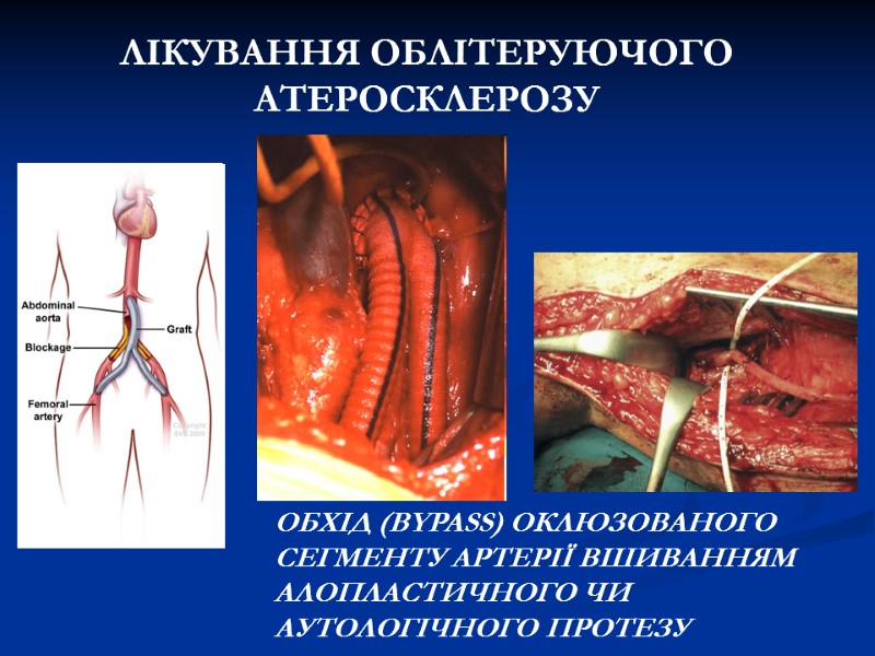 ЛІКУВАННЯ ОБЛІТЕРУЮЧОГО АТЕРОСКЛЕРОЗУ ОБХІД (BYPASS) ОКЛЮЗОВАНОГО СЕГМЕНТУ АРТЕРІЇ ВШИВАННЯМ АЛОПЛАСТИЧНОГО ЧИ АУТОЛОГІЧНОГО ЛІКУВАННЯ ОБЛІТЕРУЮЧОГО АТЕРОСКЛЕРОЗУ ОБХІД (BYPASS) ОКЛЮЗОВАНОГО СЕГМЕНТУ АРТЕРІЇ ВШИВАННЯМ АЛОПЛАСТИЧНОГО ЧИ АУТОЛОГІЧНОГО